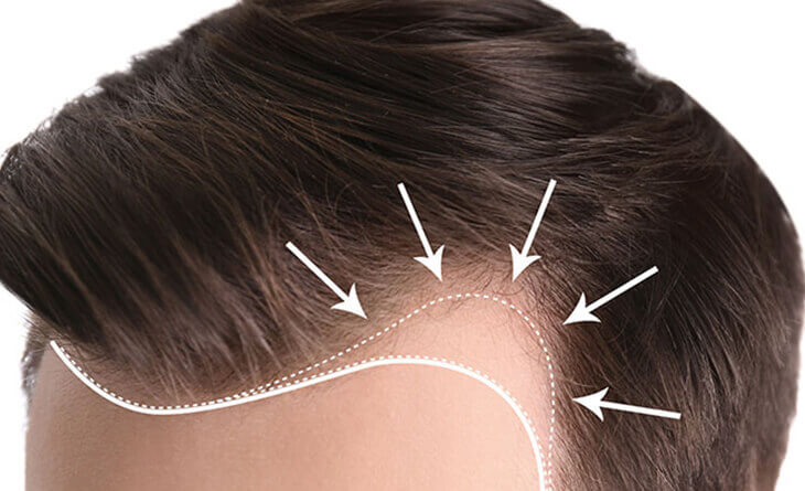 Hair Transplant in Delhi | Hair Transplant Cost | Dr. Lokesh Handa