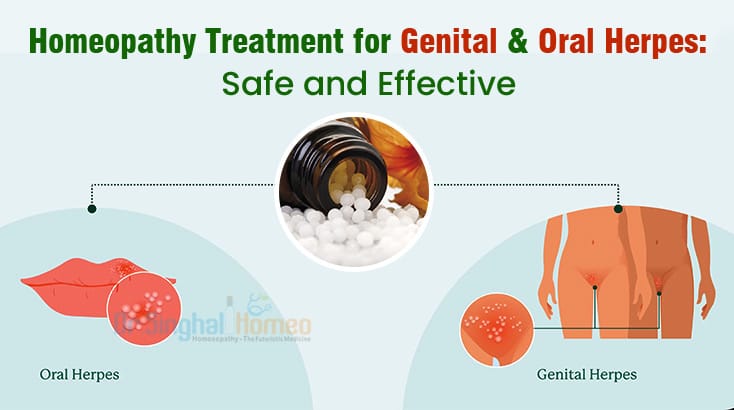 Genital Herpes vs Oral Herpes: A Comprehensive Guide
