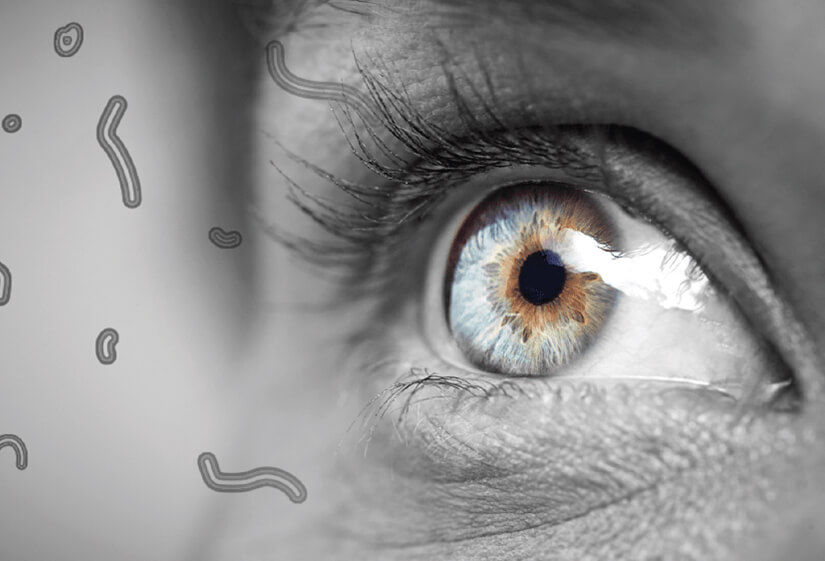 What Are Eye Floaters and what is its treatment?