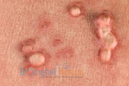 Get effective Homeopathic Treatment for HPV & Genital Warts