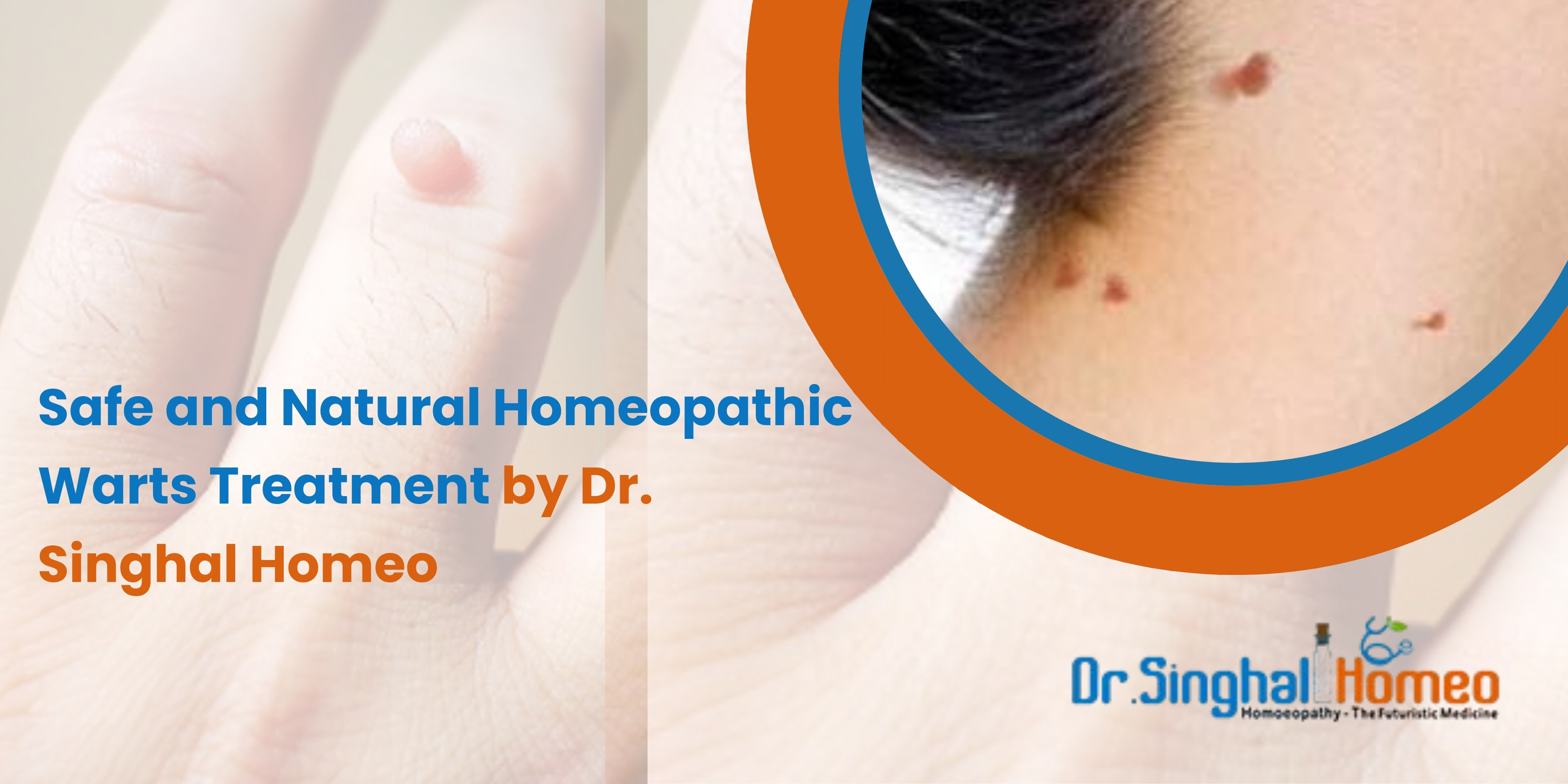 Warts Homeopathy Medicine: A Natural Approach to Skin Health – health