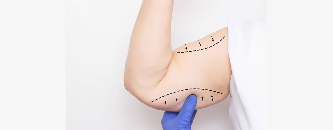 What You Need to Know About Arm Lift Surgery?