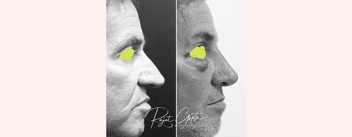 Celebrity Rhinoplasty Surgery in Delhi: Enhance Your Beauty