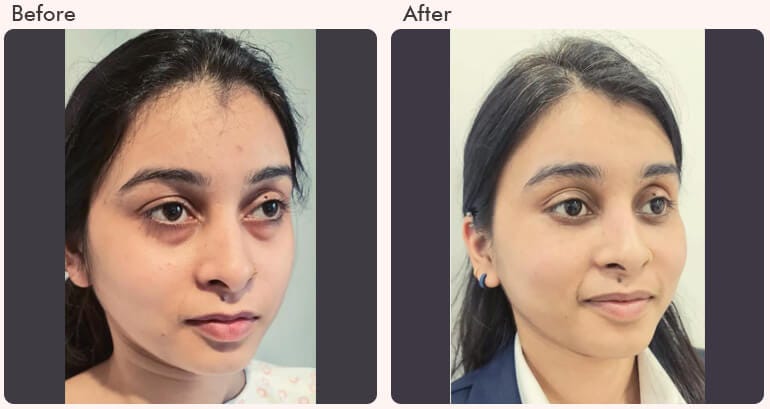 Does Blepharoplasty Remove Dark Circles? | by drrajatgupta | Jul, 2025 | Medium