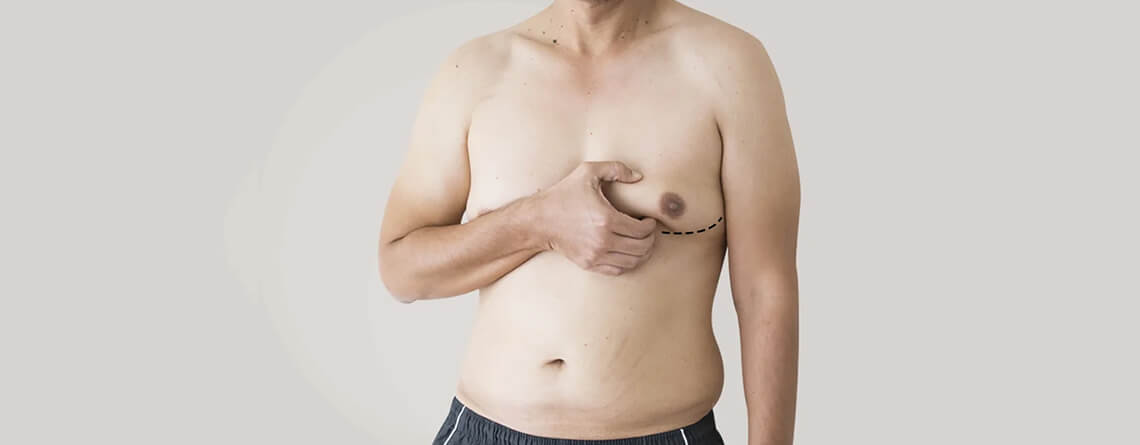 Gynecomastia Recurrence: Is It A Real Concern?