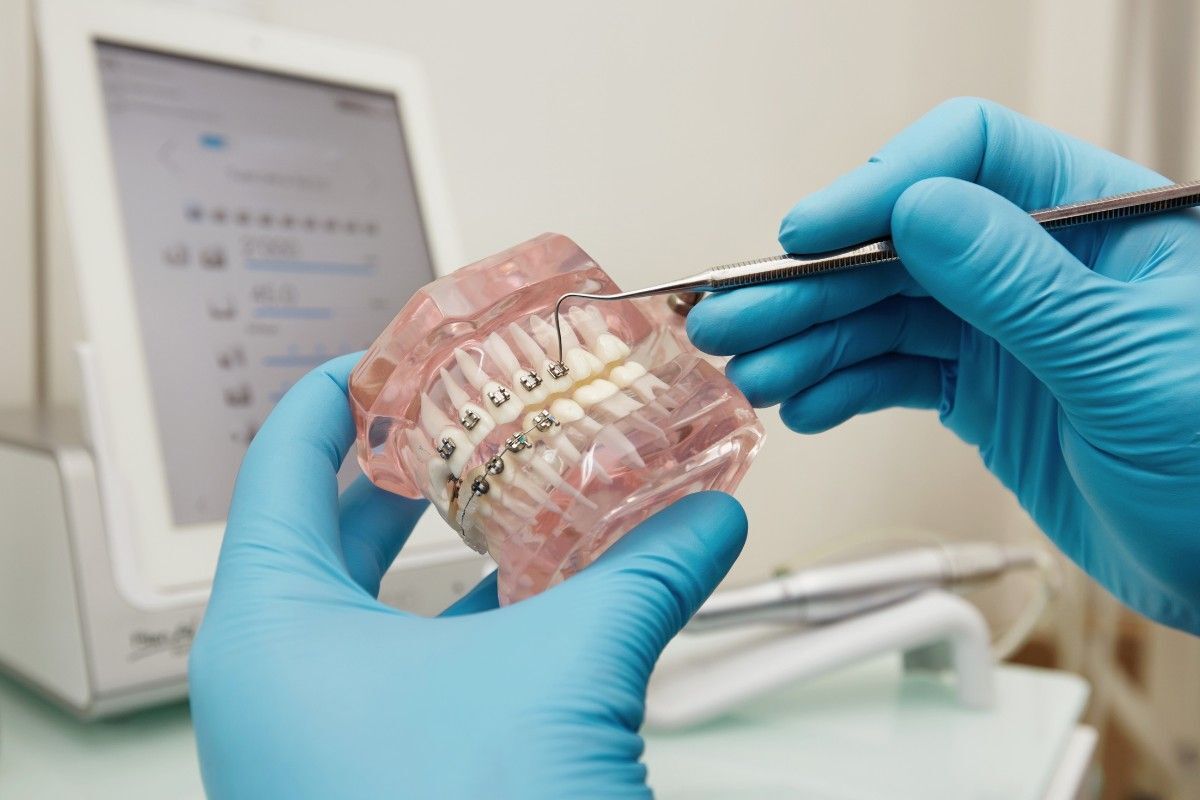 Brace Teeth Treatment in the USA | Cost, Types & Results Guide