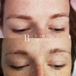 Usuwanie tatuaży kosmetycznych w Sopocie| SMPU Usuwanie