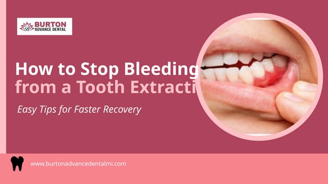How to Stop Bleeding from a Tooth Extraction: Easy Tips for Faster Recovery | PPTX