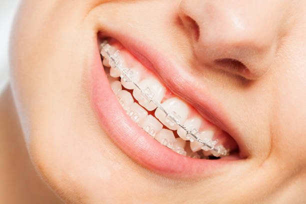 Transform Your Smile with Modern Orthodontic Solutions - The Viral Blogs